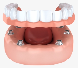 Implant Supported Model Brownstown, Mi - Snap Dentures, HD Png Download, Transparent PNG