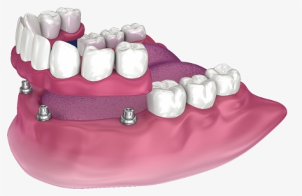 Snap On Dentures In San Diego - Full Denture With Precision Attachments, HD Png Download, Transparent PNG