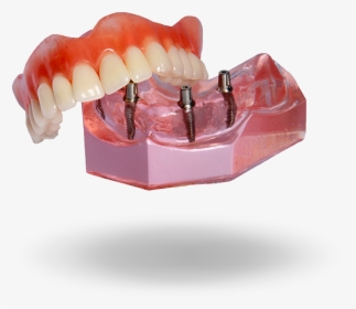 Implant Denture Model Hixson,tn - Permanent Implant Dentures, HD Png Download, Transparent PNG