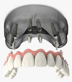 Full Arch Dental Implants Model Falls Church, Va - Bicycle Pedal, HD Png Download, Transparent PNG