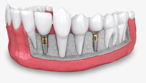 Dental Implant Model Dana Point Ca - Dental Implant, HD Png Download, Transparent PNG