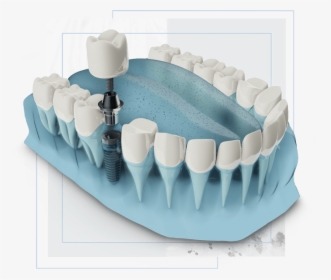 Dental Implants Graphic - Dental Implant, HD Png Download, Transparent PNG