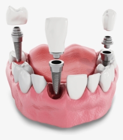 Dental Implant Model Kansas City, Mo - Implant Dentar Pret, HD Png Download, Transparent PNG