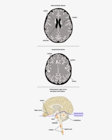 Periventricular Juxtacortical Infratentorial Spinal, HD Png Download, Transparent PNG