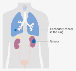 Kidneys Png , Png Download - Secondary Lung Tumor, Transparent Png, Transparent PNG