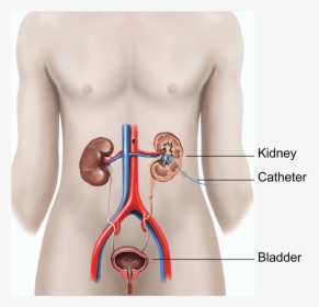 Illustration Showing A Nephrostomy - Kidney Catheter, HD Png Download, Transparent PNG