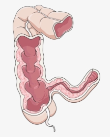 Crohn's Disease Png, Transparent Png, Transparent PNG