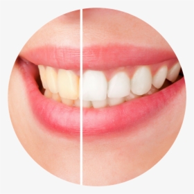 Before And After Teeth Whitening, HD Png Download, Transparent PNG