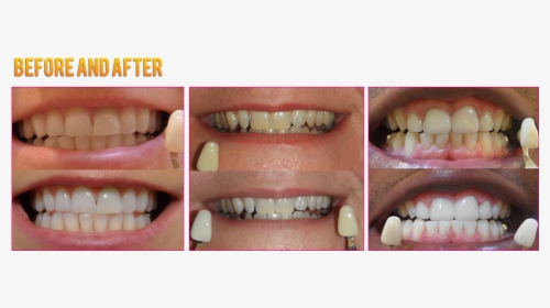 Led Teeth Whitening Coupons Led Teeth Whitening Before - Colorfulness, HD Png Download, Transparent PNG
