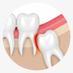 My Teeth Are Becoming Transparent Impaction Teeth Png - Impacted Wisdom Tooth, Png Download, Transparent PNG