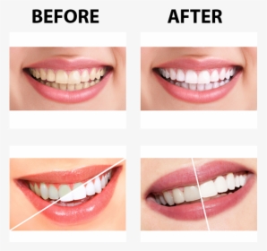 Parodontax Toothpaste Before And After, HD Png Download, Transparent PNG