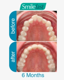 Aqd Smilefast After 6-months - Fast Braces Buck Teeth Before And After, HD Png Download, Transparent PNG