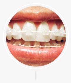 White And Silver Braces, HD Png Download, Transparent PNG