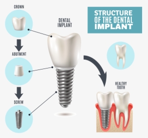 Part Of Dental Implant, HD Png Download, Transparent PNG
