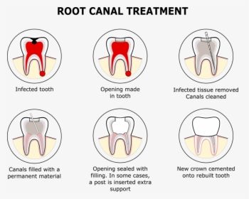 Root Canal Filling Replacement, HD Png Download, Transparent PNG