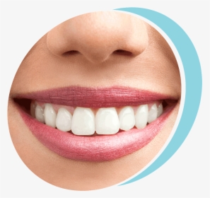 Patient Smiling After Laser Soft Tissue Recontouring - Before And After Smile, HD Png Download, Transparent PNG