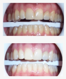 Austin Teeth Whitening - Zoom Whitening Before And After, HD Png Download, Transparent PNG