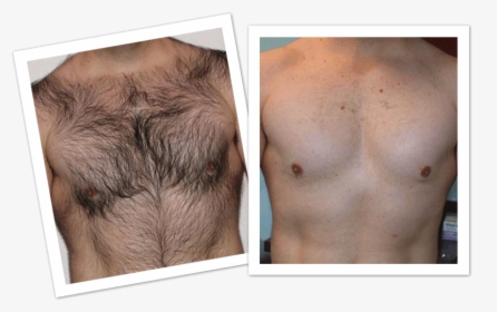 Mens Laser Hair Removal Before And After, HD Png Download, Transparent PNG
