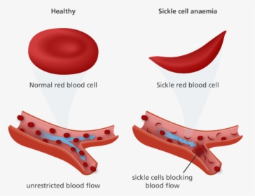 Cotton Clipart White Blood Cell - Red Blood Cell Sickle Cell, HD Png Download, Transparent PNG