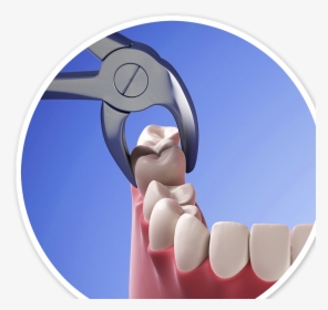 Horizon Microscope Enhanced Dentistry - Tooth Extraction Data, HD Png Download, Transparent PNG