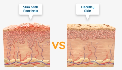Diagram Of Skin With Psoriasis Vs Healthy Skin - Psoriasis Dead Skin Cell, HD Png Download, Transparent PNG