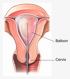 Illustration Showing A Thermal Balloon Endometrial - Uterine Ablation, HD Png Download, Transparent PNG