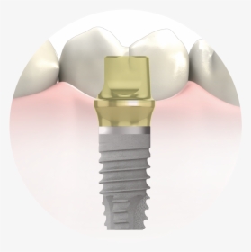 Dental Implant Procedures In Manhattan - Circle, HD Png Download, Transparent PNG