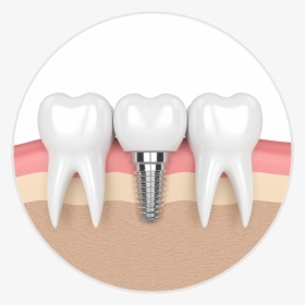 Dental Implant Illustration - Dental Implants, HD Png Download, Transparent PNG