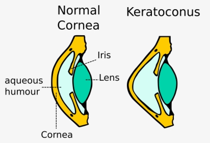 Kerataconus Image - Diagram Of Keratoconus, HD Png Download, Transparent PNG