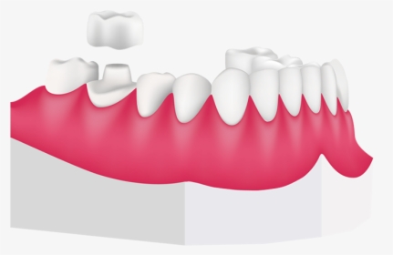 Tooth Clipart Crown Clipart Royalty Free Stock Dental, HD Png Download, Transparent PNG