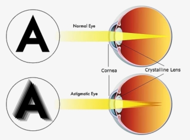 Astigmatism See, HD Png Download, Transparent PNG
