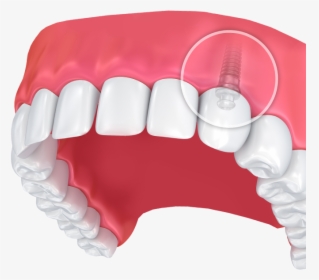 Upper Dental Arch With Zoomed In Internal View Of Dental, HD Png Download, Transparent PNG