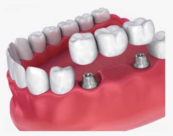Implant-supported Bridge - Dental Crown, HD Png Download, Transparent PNG