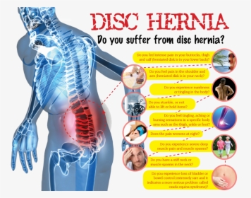 Spine Surgery Infographic, HD Png Download, Transparent PNG