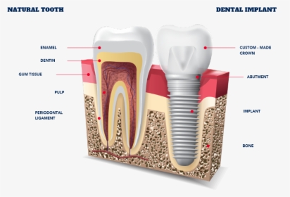 Tooth Implant, HD Png Download, Transparent PNG