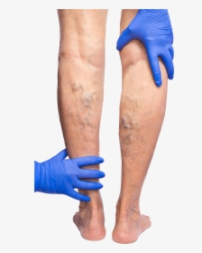 Gloved Hands Feeling The Backs Of Legs That Are Covered - Phlebitis Varicose Veins, HD Png Download, Transparent PNG