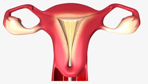 Endometrial Ablation, HD Png Download, Transparent PNG