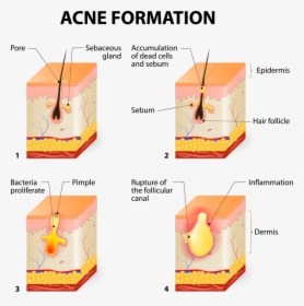 Acne Formation, HD Png Download, Transparent PNG