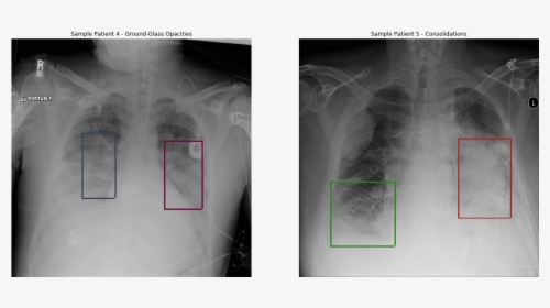 Pneumonia Detection, HD Png Download, Transparent PNG