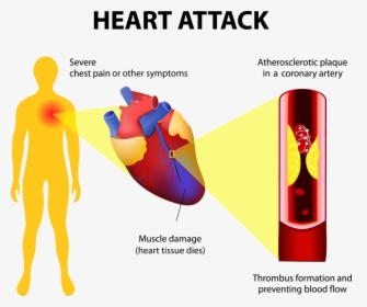 Transparent Attack Clipart - First Aid Heart Attack Symptoms, HD Png Download, Transparent PNG