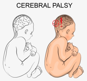 How Can I Tell If My Child Has Cerebral Palsy - Cerebral Palsy Illustration, HD Png Download, Transparent PNG