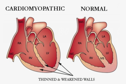 Cardiomyopathy Heart, HD Png Download, Transparent PNG