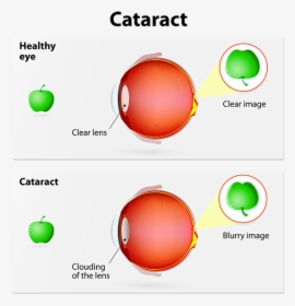 Cataract - Cataract Ray Diagrams, HD Png Download, Transparent PNG