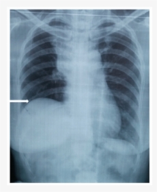 Elevated Right Hemidiaphragm X Ray, HD Png Download, Transparent PNG