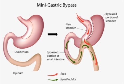 Mini-gastric Bypass, HD Png Download, Transparent PNG