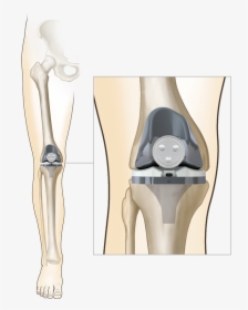 Total Knee Replacement Femur, HD Png Download, Transparent PNG