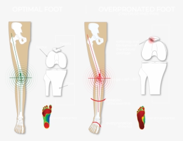 Optimal Foot Vs Over Pronated Foot And Knee Pain - Pronation Foot, HD Png Download, Transparent PNG