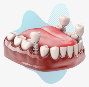Dental Implant Model - Pasang Gigi Palsu Geraham, HD Png Download, Transparent PNG