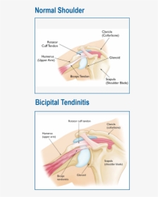 Shoulder Tendonitis Diagram, HD Png Download, Transparent PNG