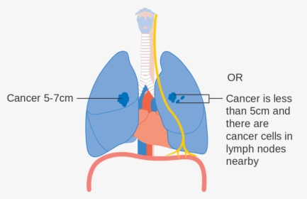 Stage 1 Early Stage Lung Cancer, HD Png Download, Transparent PNG